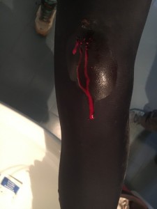 Gnarly lookin' battle wound that somehow seeped through my tights